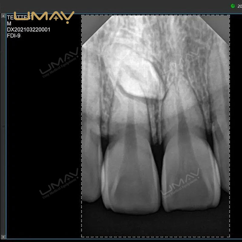 Portable Digital Dental X-ray Unit with Intraoral Radiography Sensor for Oral Treatment