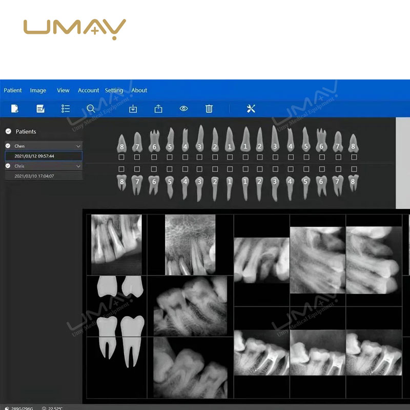 Portable USB Digital Intraoral X-Ray Sensor for Dental Imaging